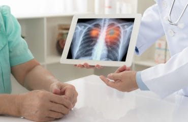 Cara Mendeteksi Kanker Paru dengan 5 Pilihan Tes Skrinning