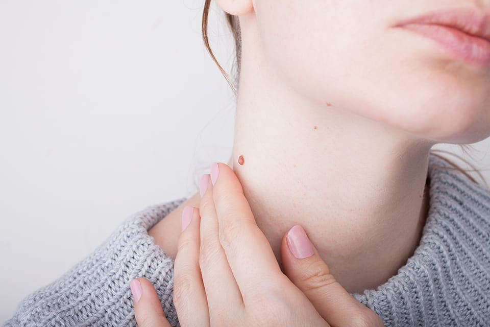 Kanker Kulit Melanoma