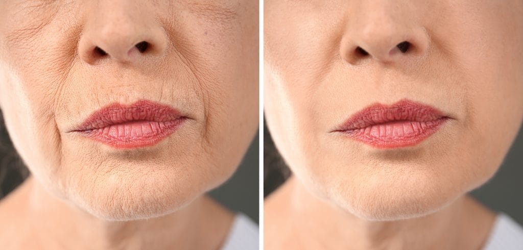 hasil botox