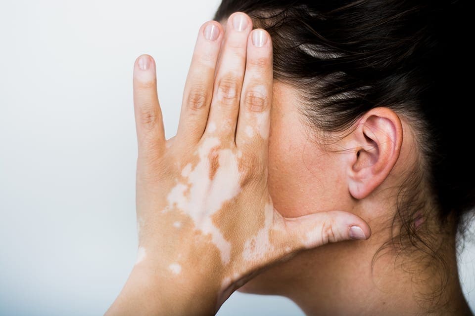 Penyakit Kulit Vitiligo