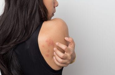 Apa itu Selulitis dan Penyebabnya?