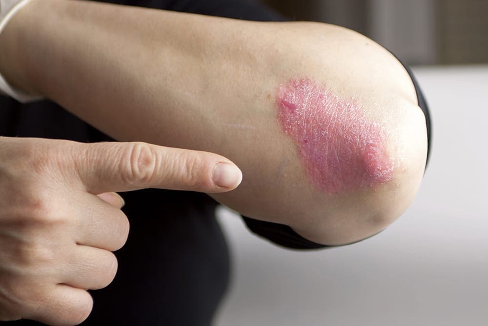psoriasis adalah