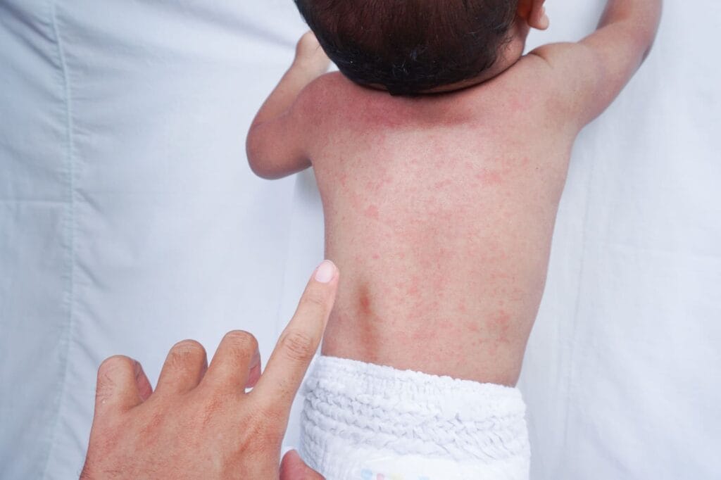 Cara mengatasi biang keringat pada bayi 