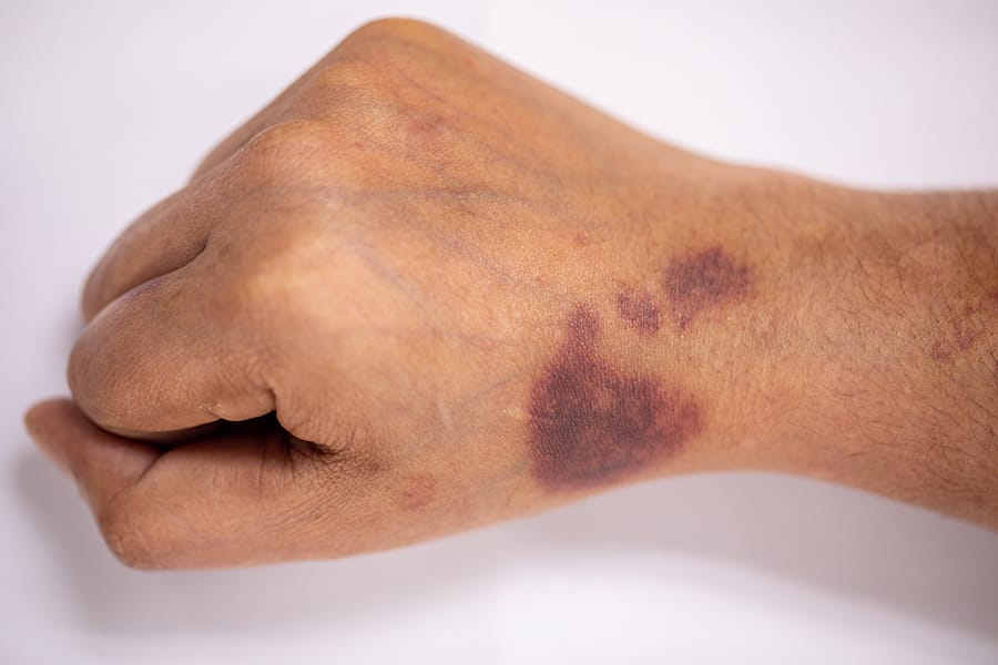 Apakah penderita hemofilia bisa disembuhkan?