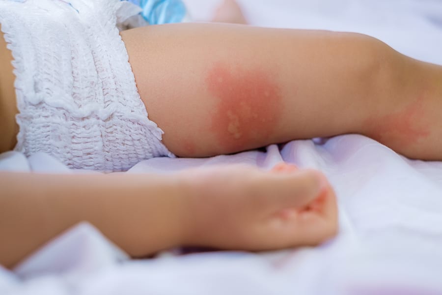 Penaganan Alergi Telur pada Anak dan Dewasa