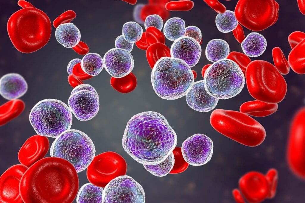 leukemia adalah