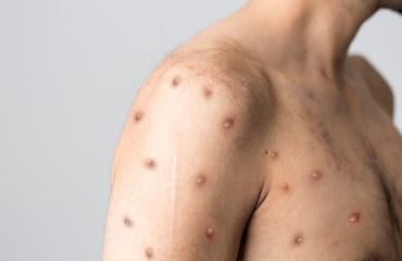 penularan virus cacar monyet