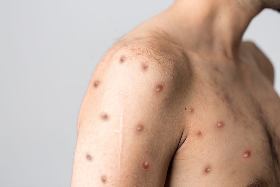 penularan virus cacar monyet