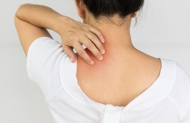 Bagaimana cara agar tidak terjangkit penyakit menular pada kulit