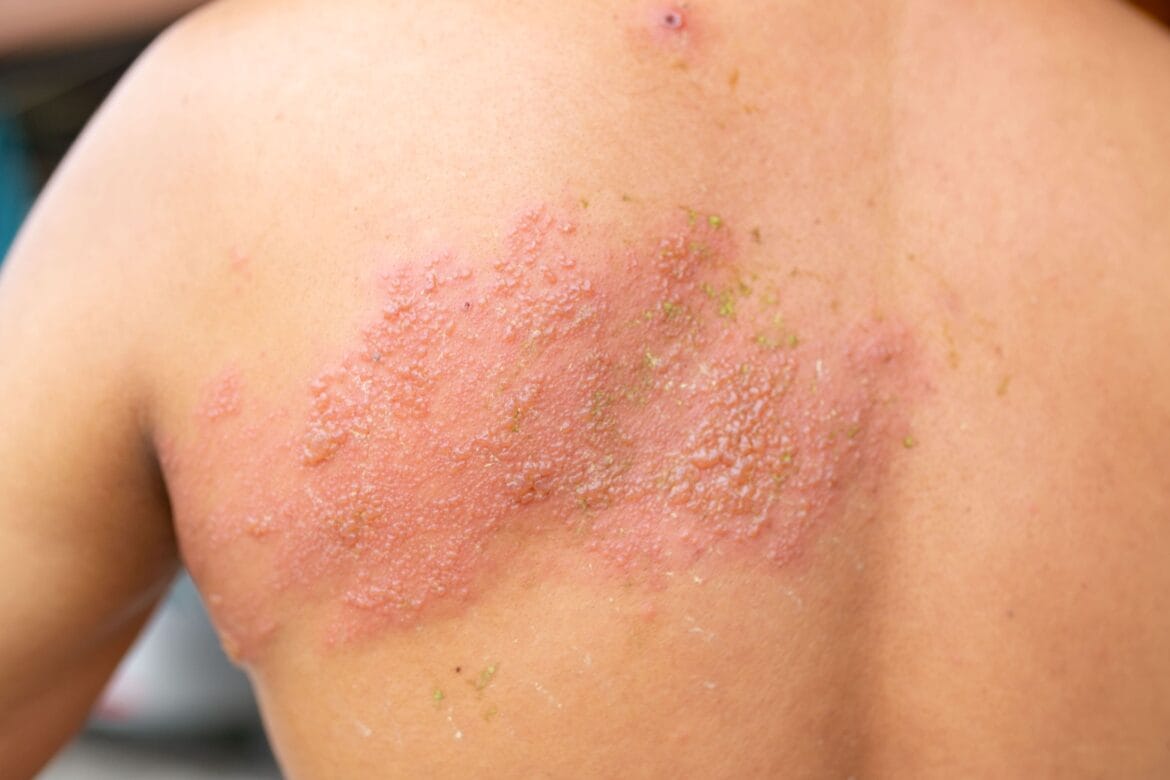 jenis herpes