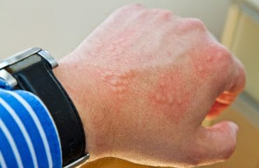 perbedaan herpes dan cacar air