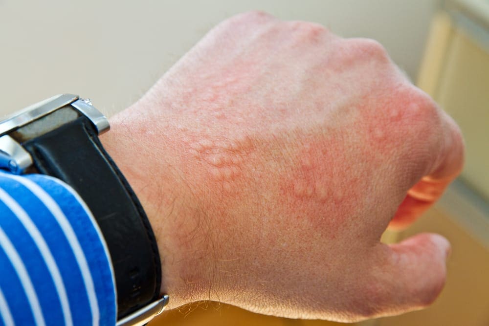 perbedaan herpes dan cacar air