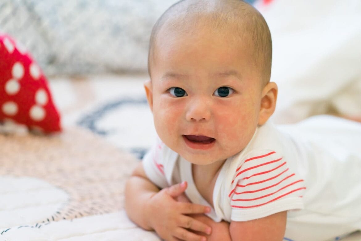 campak pada bayi