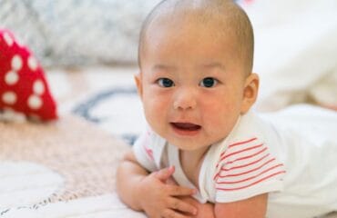 campak pada bayi