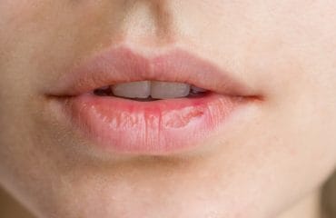 penyebab bibir kering saat puasa