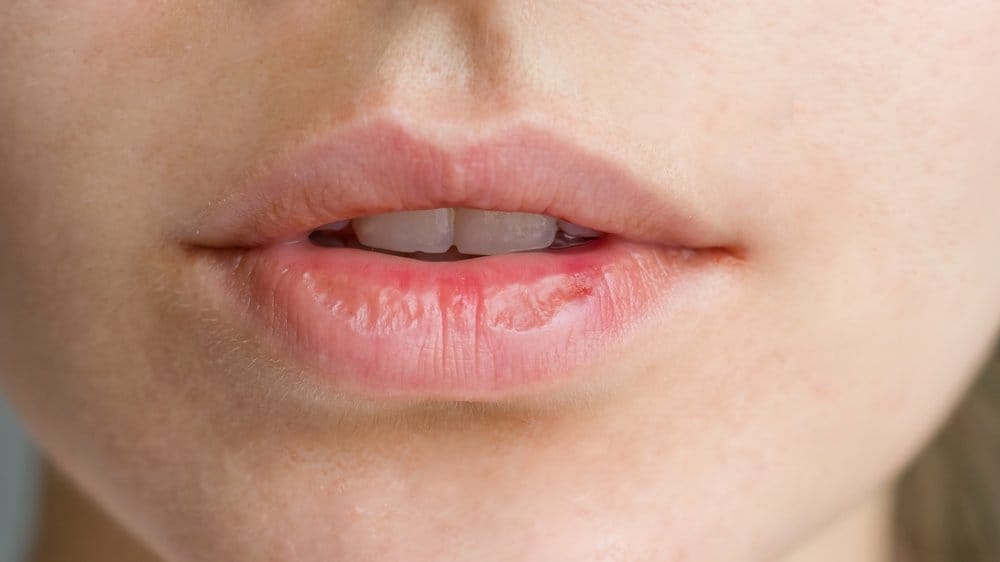 penyebab bibir kering saat puasa