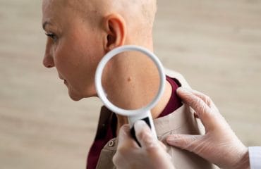 kutil gejala hpv