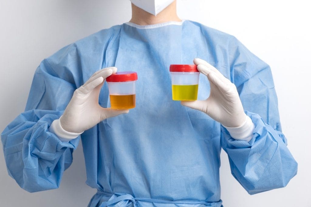 warna urine tanda diabetes