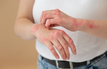 apa itu herpes