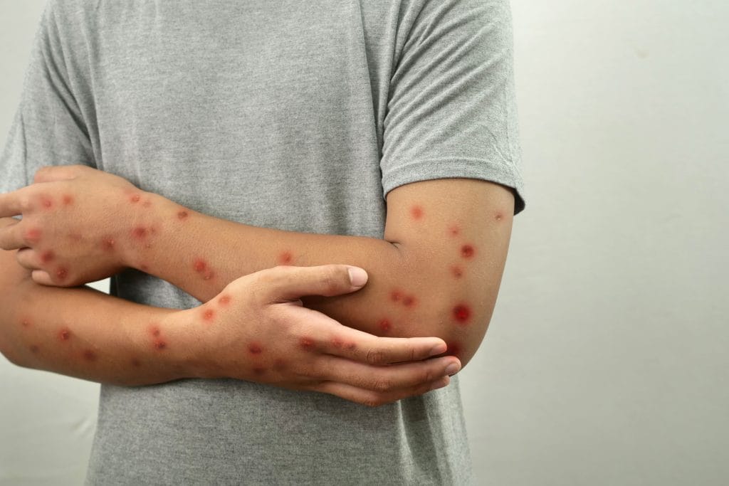mpox atau cacar monyet