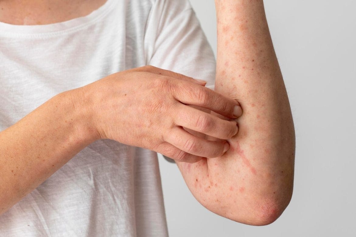 perbedaan flu singapura dan cacar air