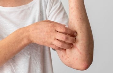 perbedaan flu singapura dan cacar air