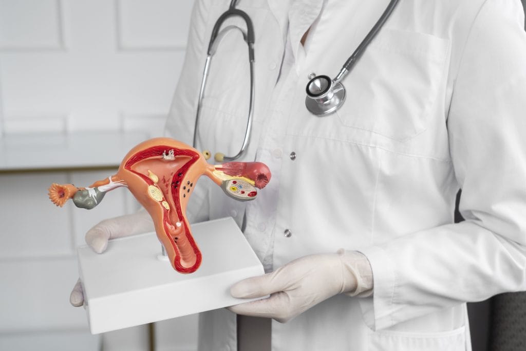 pcos adalah