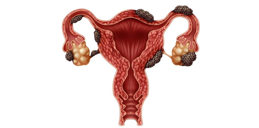 Endometriosis adalah