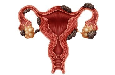 Endometriosis adalah