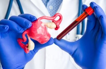 biaya tes pcos