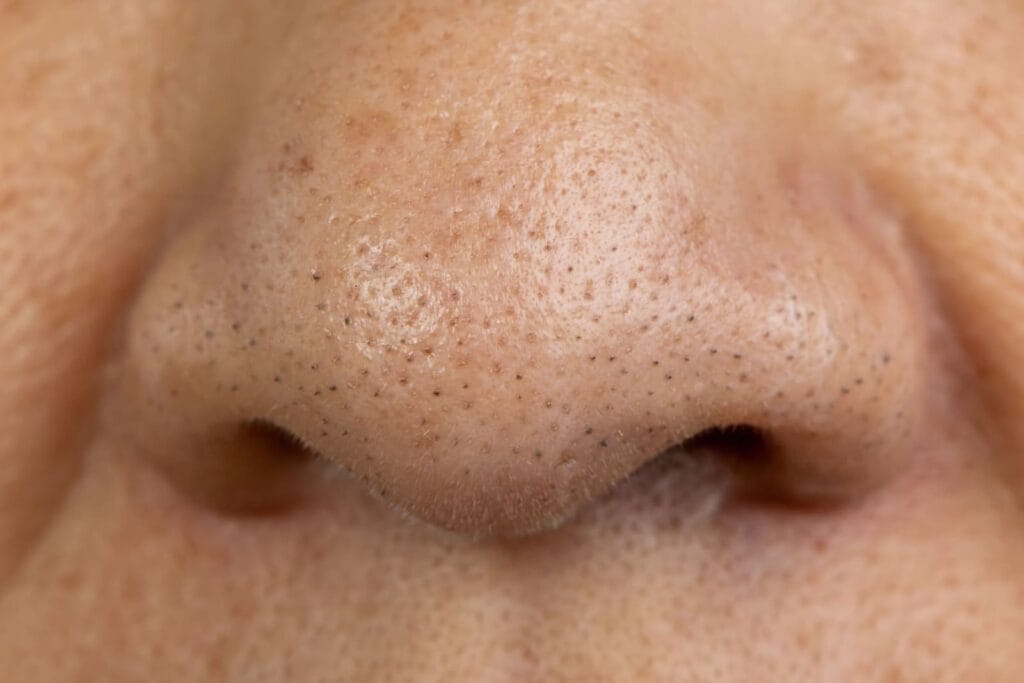 komedo di hidung