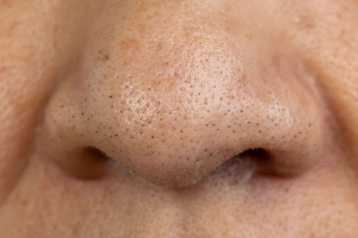 komedo di hidung