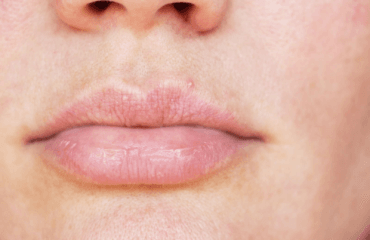 penyebab bintik putih pada bibir