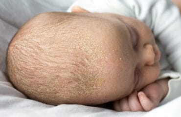 cara menghilangkan kerak di kepala bayi