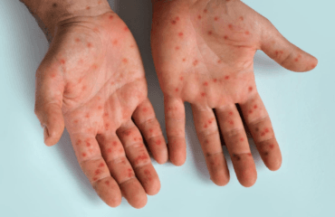 cara mengobati bintik merah pada kulit