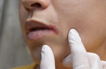 penyakit kanker bibir