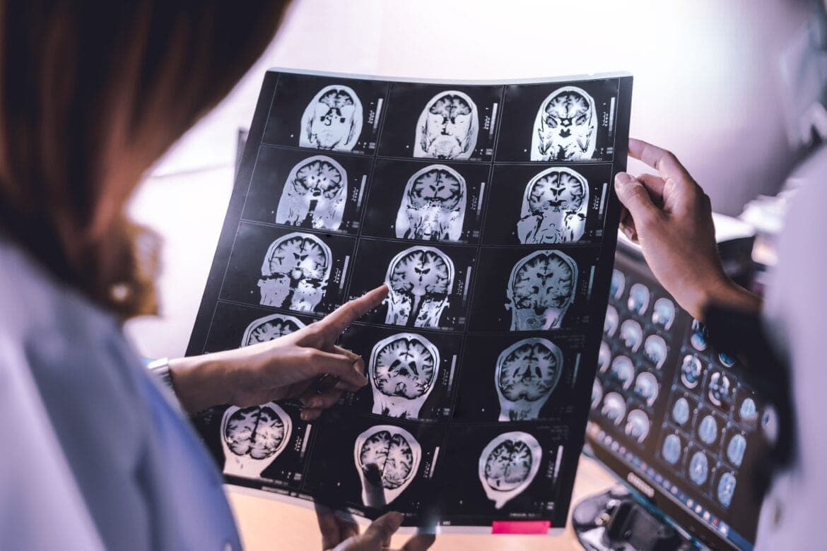 Cerebral atrophy adalah