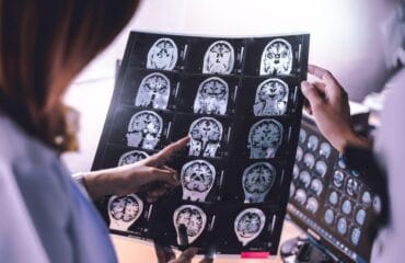 Cerebral atrophy adalah