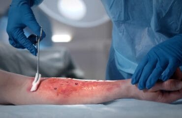 ciri-ciri luka infeksi