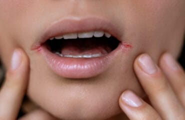 herpes di bibir