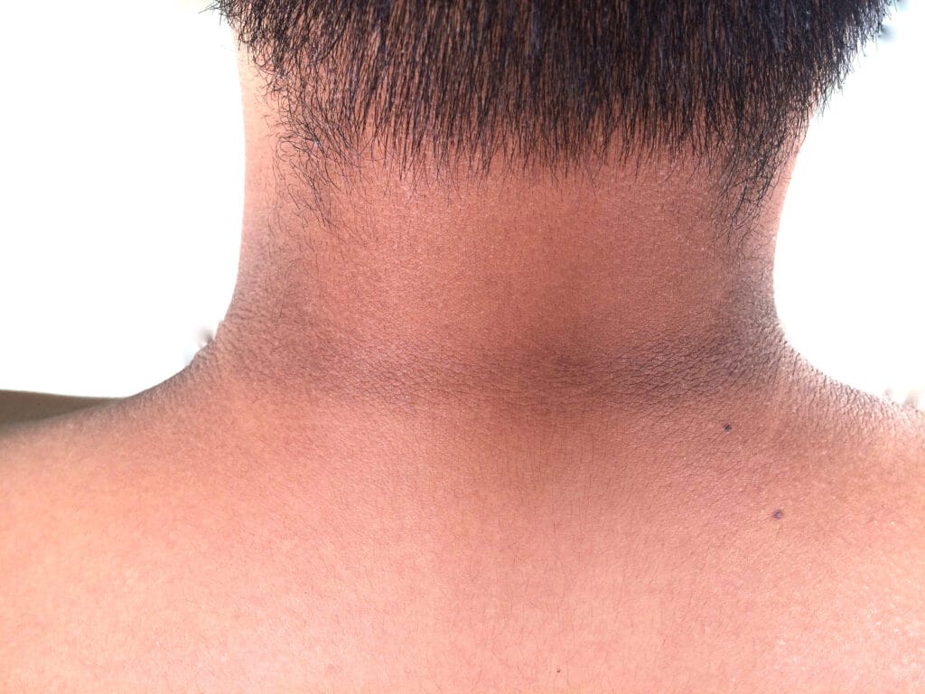 Penyebab leher hitam