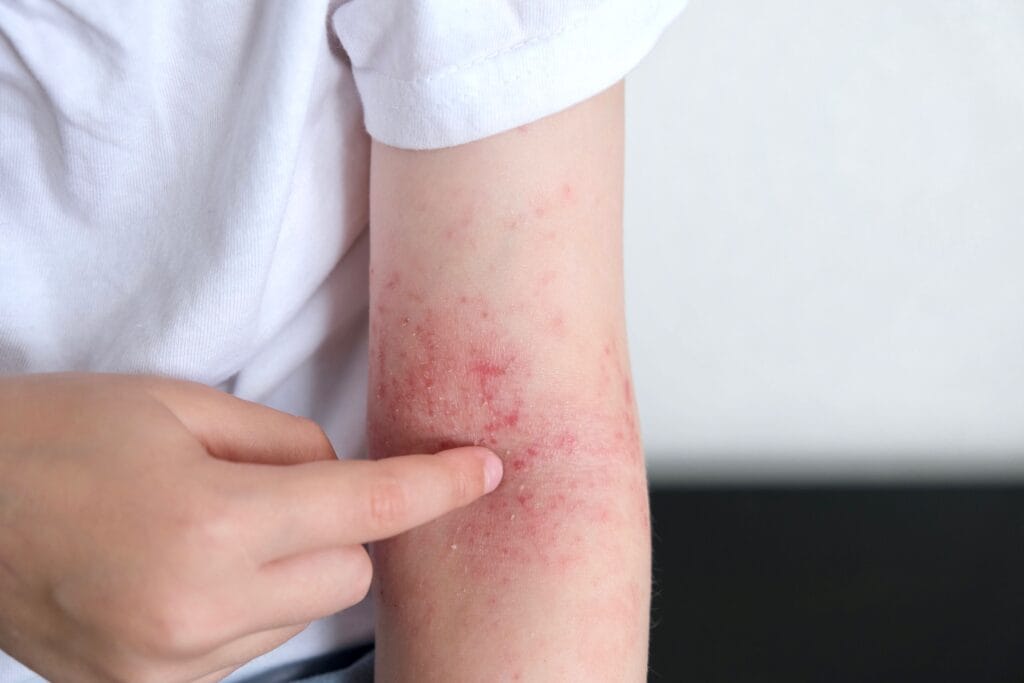 Petechiae adalah