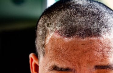 Tinea Capitis adalah