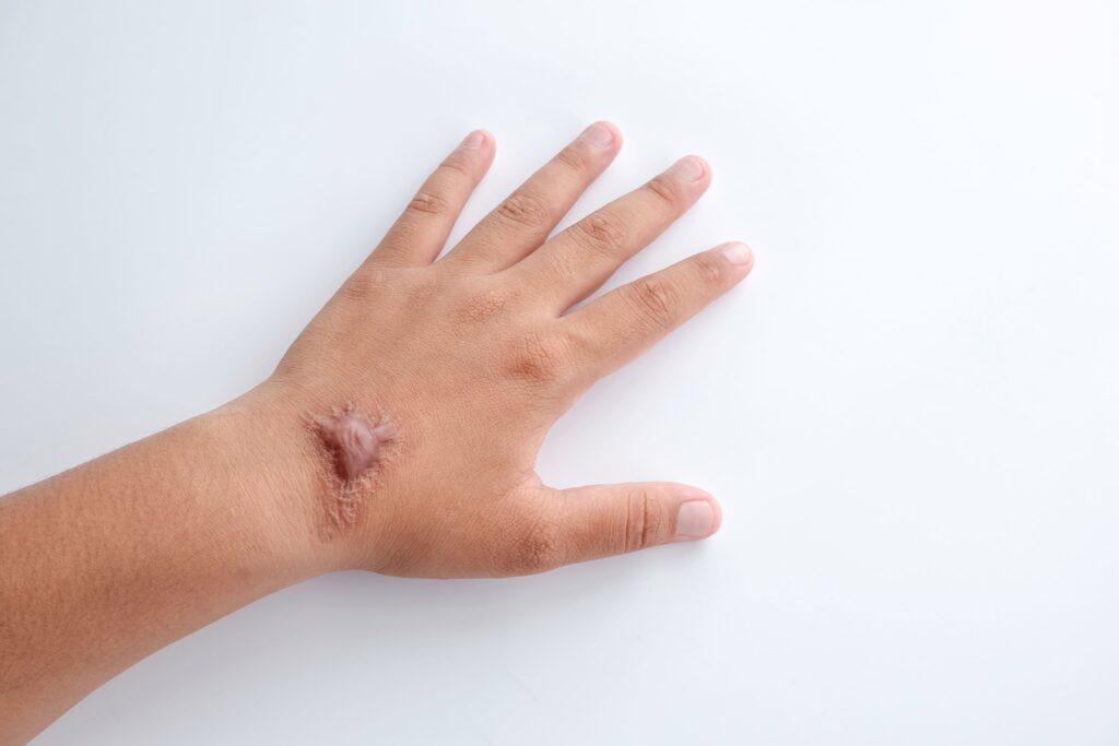 keloid adalah