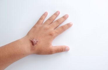 keloid adalah
