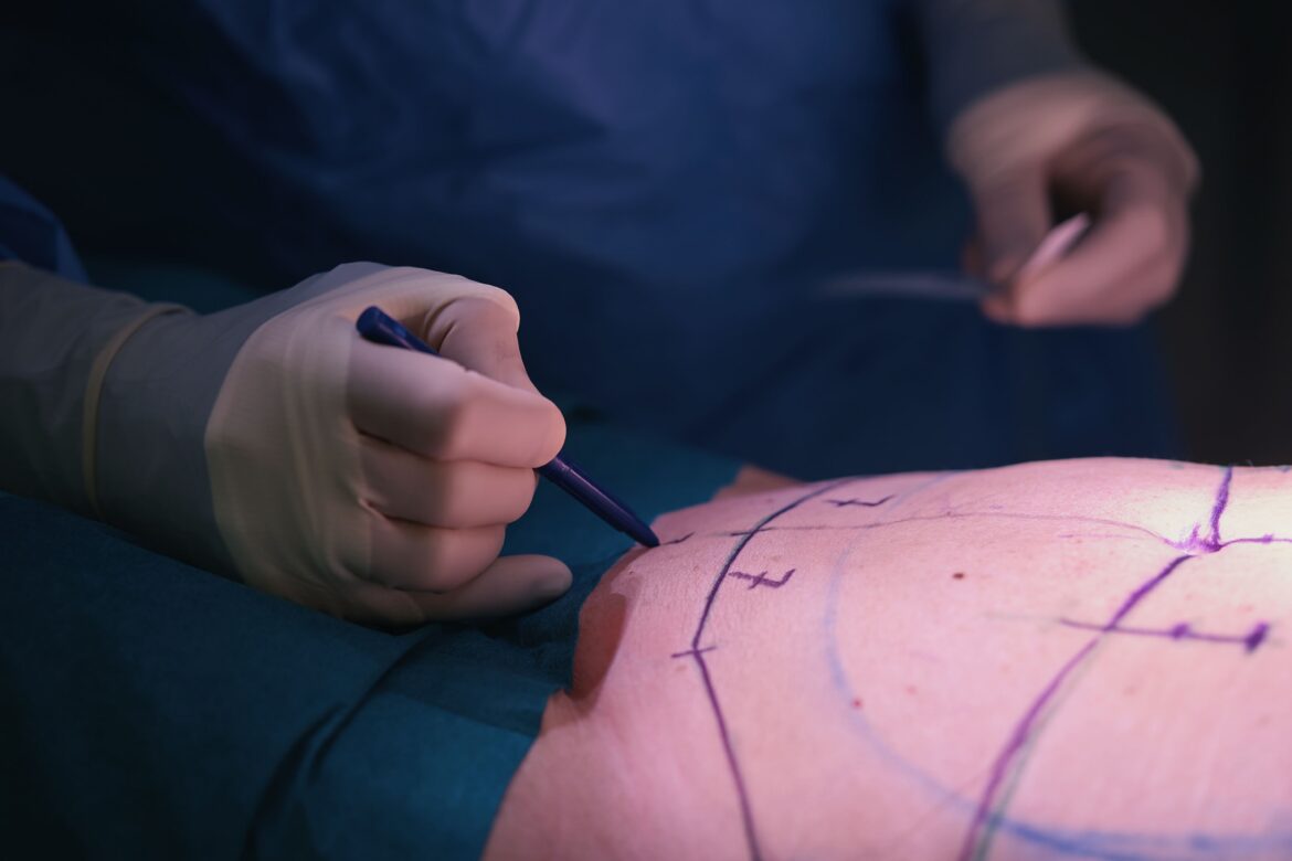 Tummy Tuck Adalah