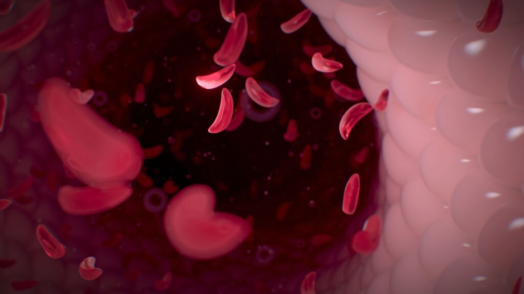Anemia sel sabit adalah