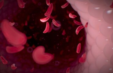 Anemia sel sabit adalah
