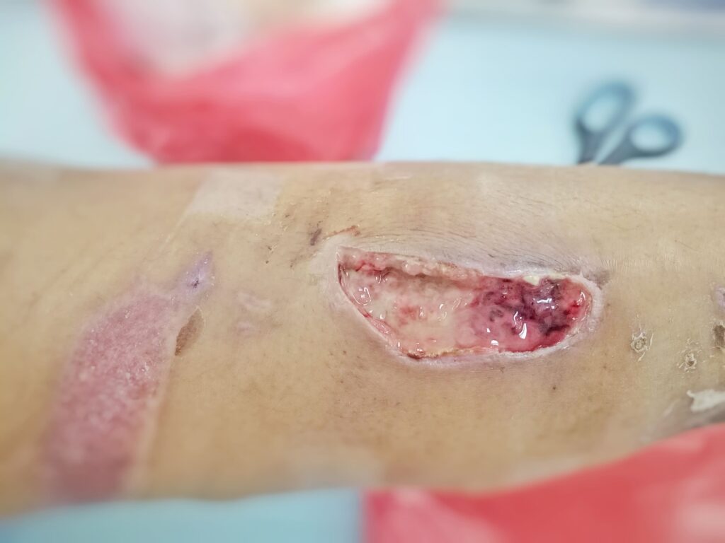 ulkus dekubitus adalah