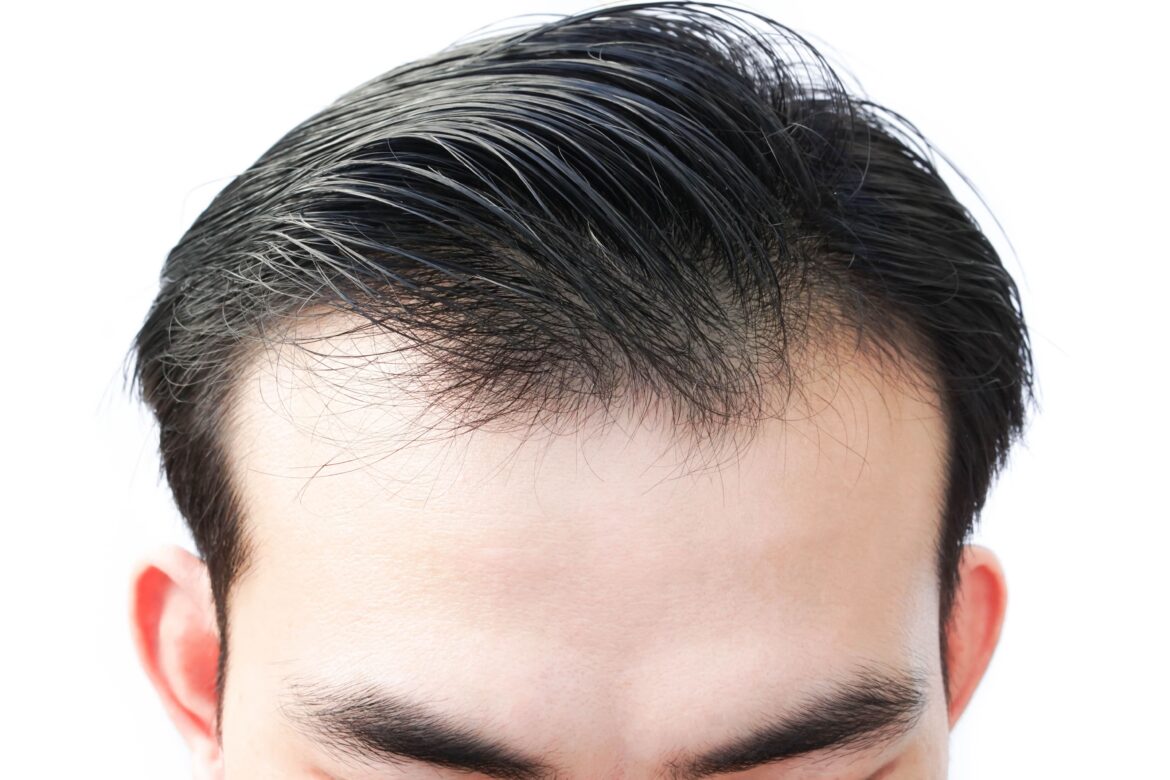 Garis rambut mundur